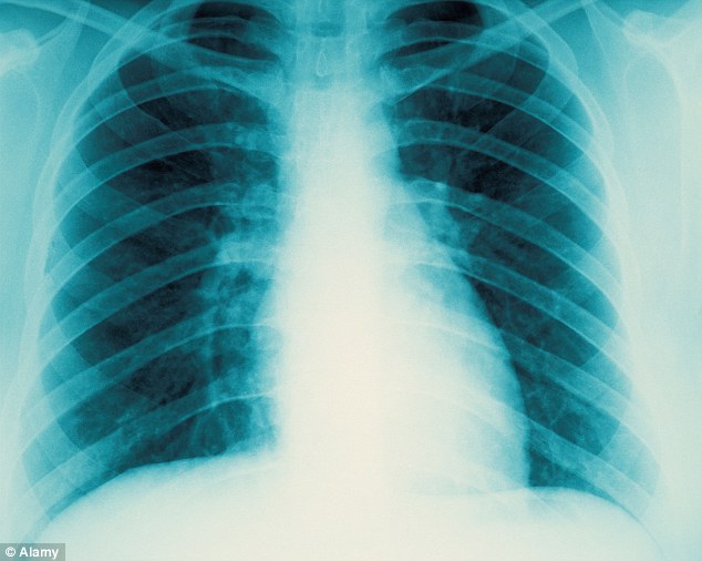 1410810138131_wps_1_A_Close_up_of_chest_x_ray